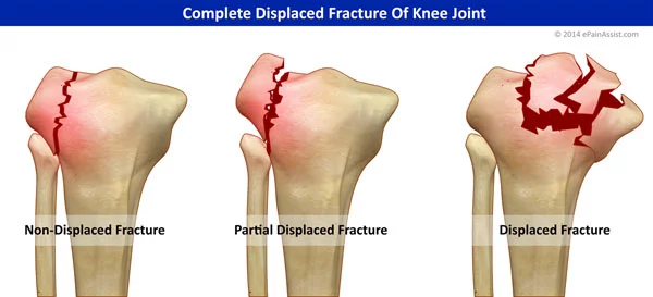 Knee Pain – When Do I Need to See a Doctor
