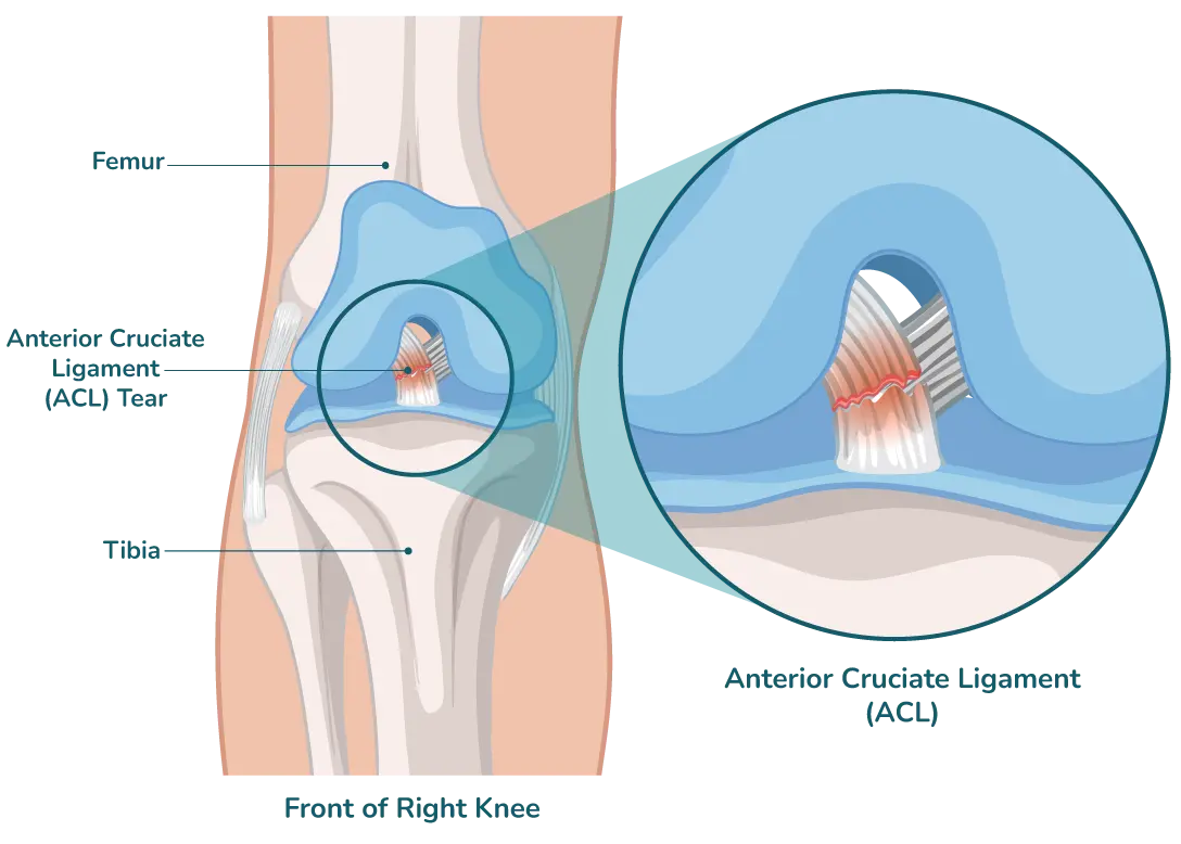 https://orthokinetics.sg/wp-content/uploads/2025/09/image_OrthoKinetics_ACL.webp