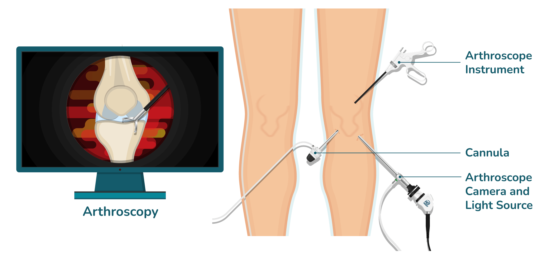 https://orthokinetics.sg/wp-content/uploads/2025/09/image_OrthoKinetics_Arthroscopy-min.png