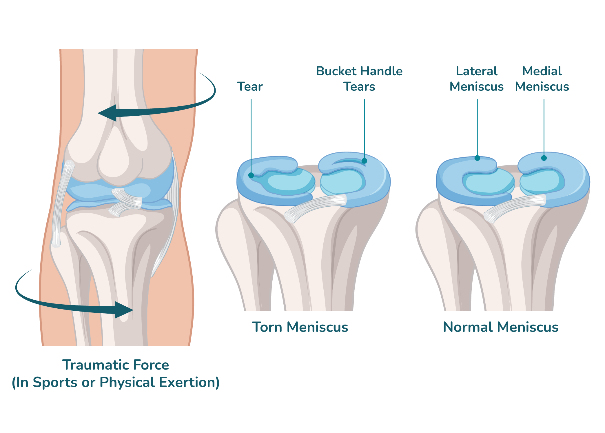 https://orthokinetics.sg/wp-content/uploads/2025/09/image_OrthoKinetics_Meniscus-min.png