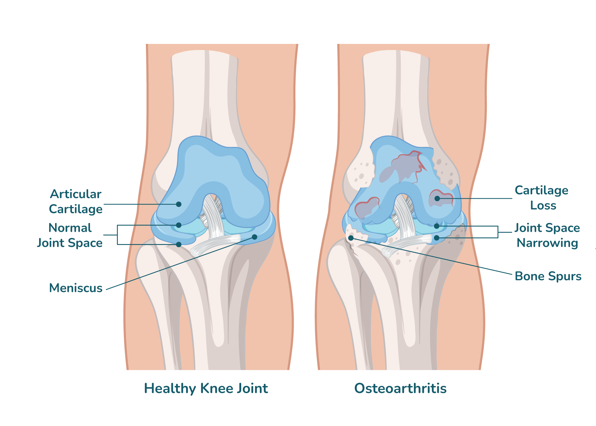 https://orthokinetics.sg/wp-content/uploads/2025/09/image_OrthoKinetics_Osteoarthritis-min.png