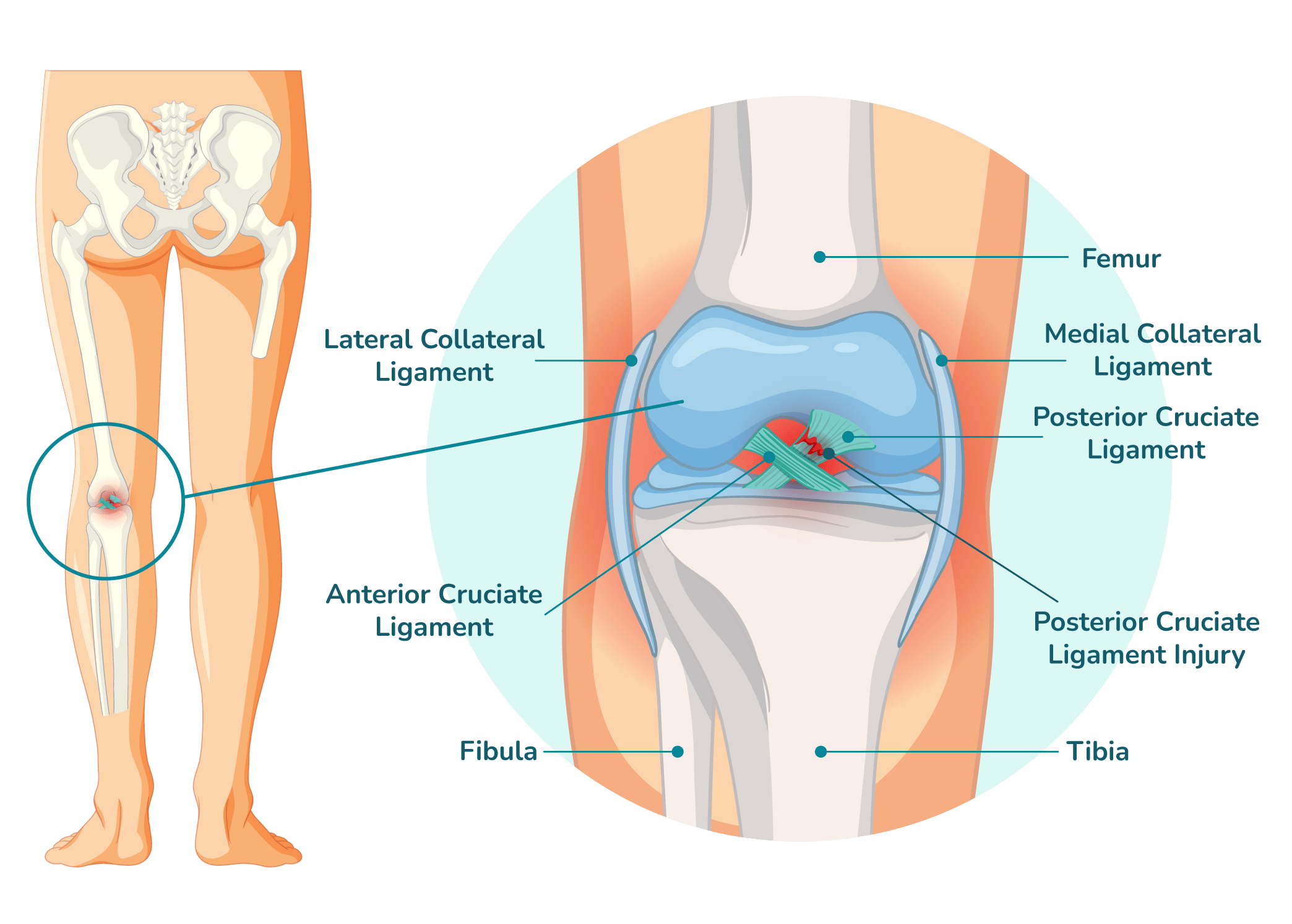 https://orthokinetics.sg/wp-content/uploads/2025/09/image_OrthoKinetics_PCL-min.png